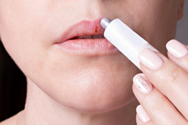 Опасен ли герпес на губах и другие вопросы о неприятной болячке