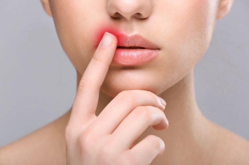 Опасен ли герпес на губах и другие вопросы о неприятной болячке