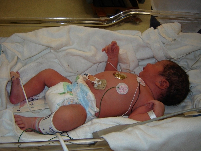 На Украине у женщины с COVID-19 родился ребенок с редчайшей патологией