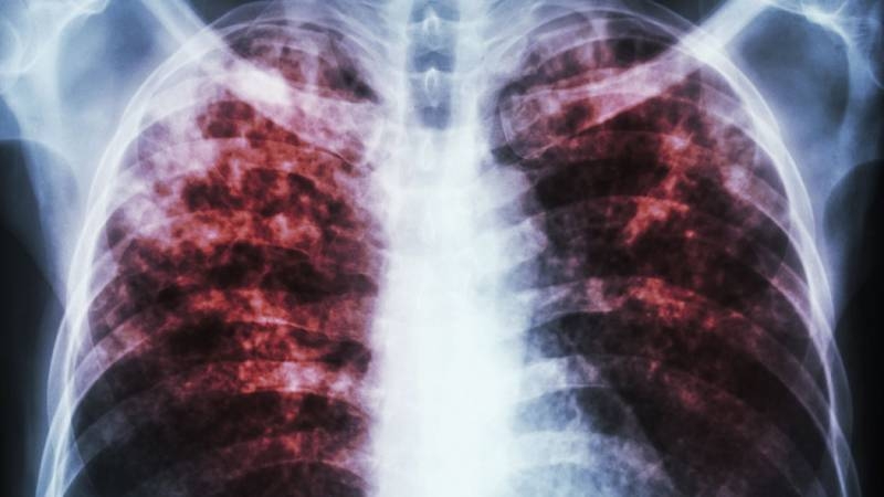 
Мясников предупредил о возможной вспышке туберкулеза в России                