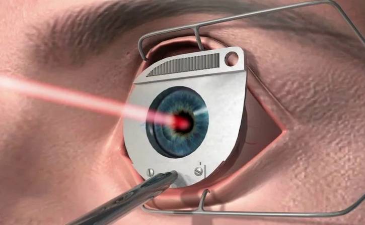 
Делать ли лазерную коррекцию людям с плохим зрением: плюсы и минусы                